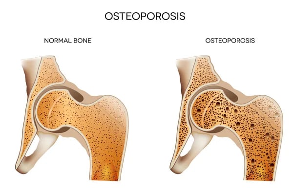 illustration-osteoporosis