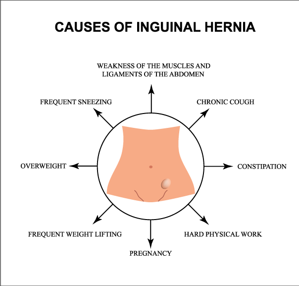 inguinal-hernia-[Converted]