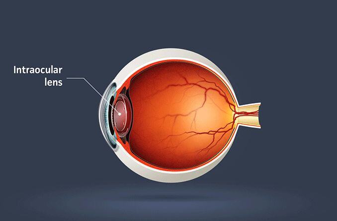 Premium Intraocular lenses