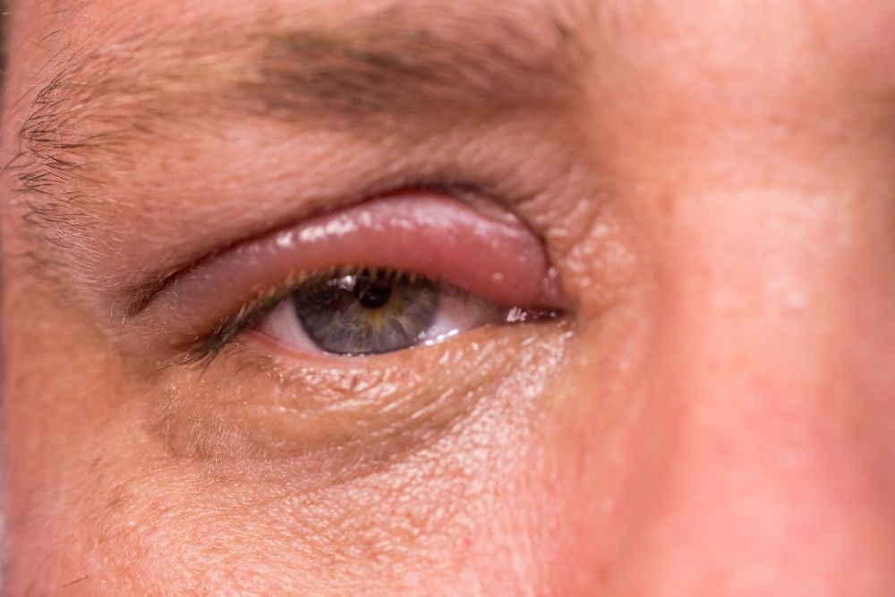 Botox for blepharospasm