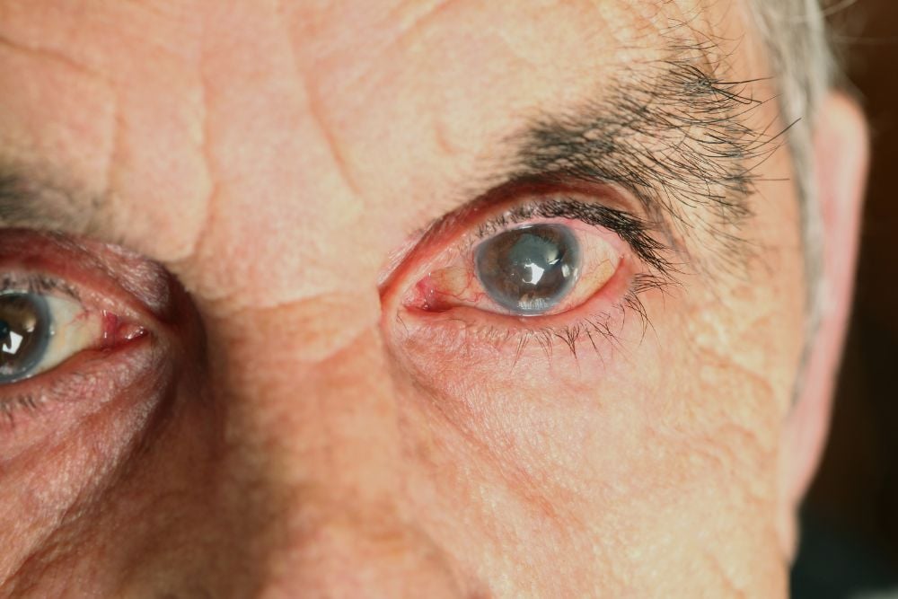 Cataract Eye Treatment Dubai