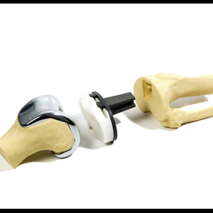 Knee Replacement Surgery Knee Replacement Surgery
