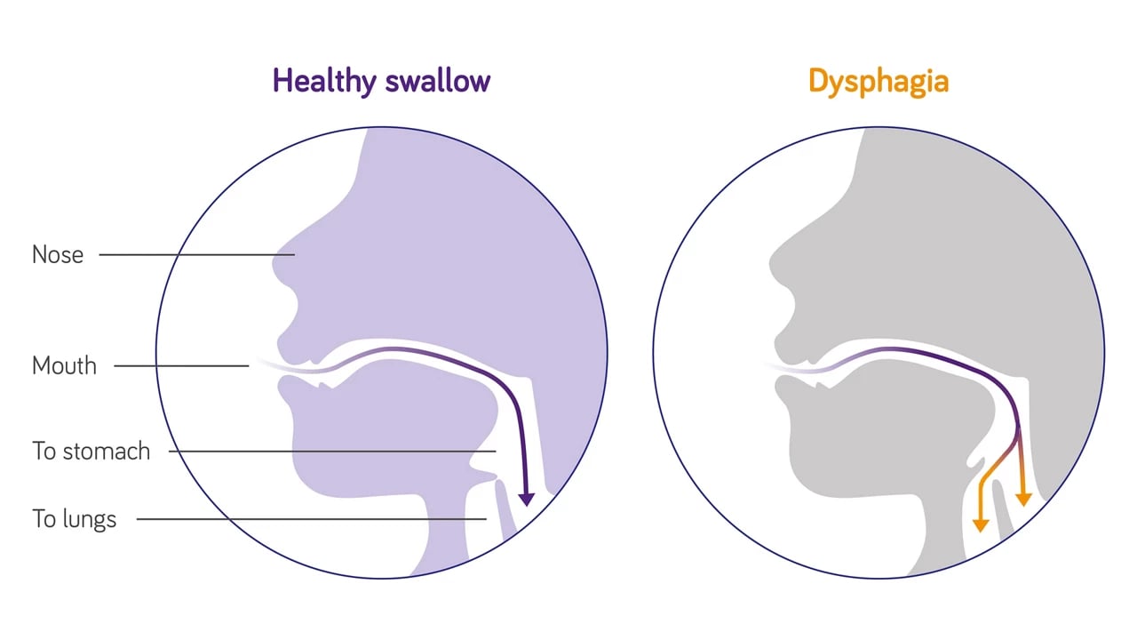 nutricia-stroke-dysphagia-swallowing-difficulties-illustration-3840-2160px-1