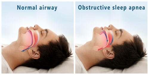 obstructive sleep apnea