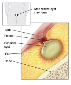 Pilonidal cyst - Dubai Hemorrhoids Clinic