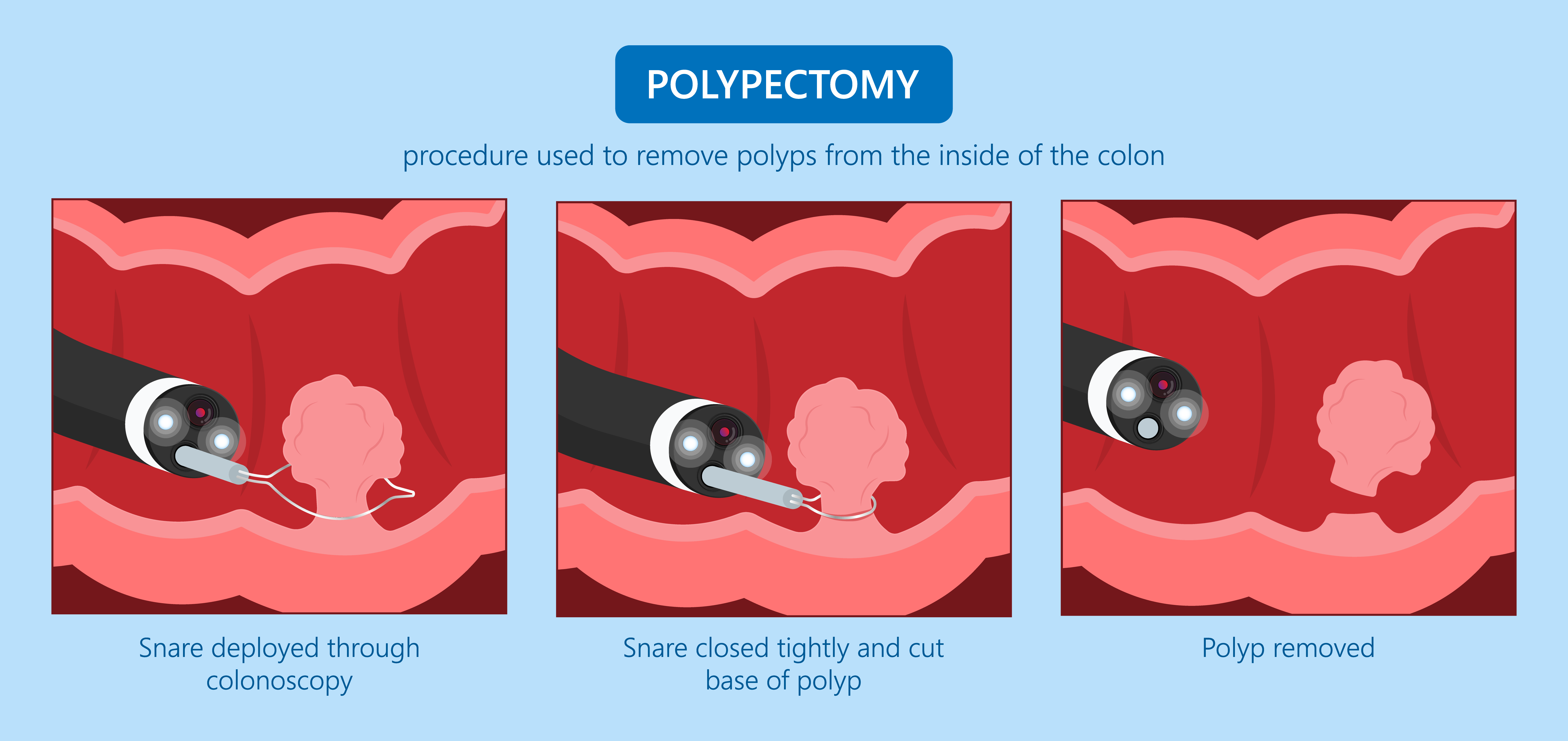 polypectomy-[Converted]