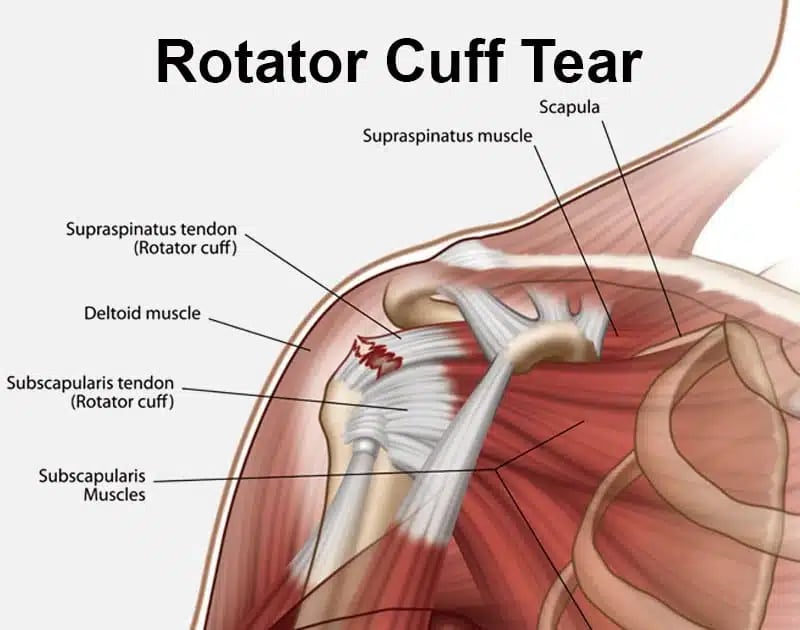 rotator-cuff-tear-small