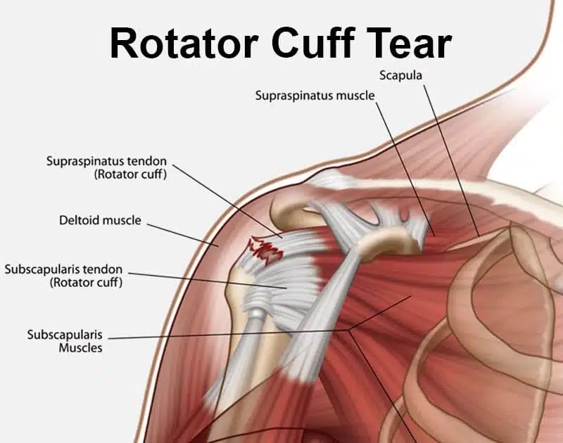 Rotator Cuff Tear