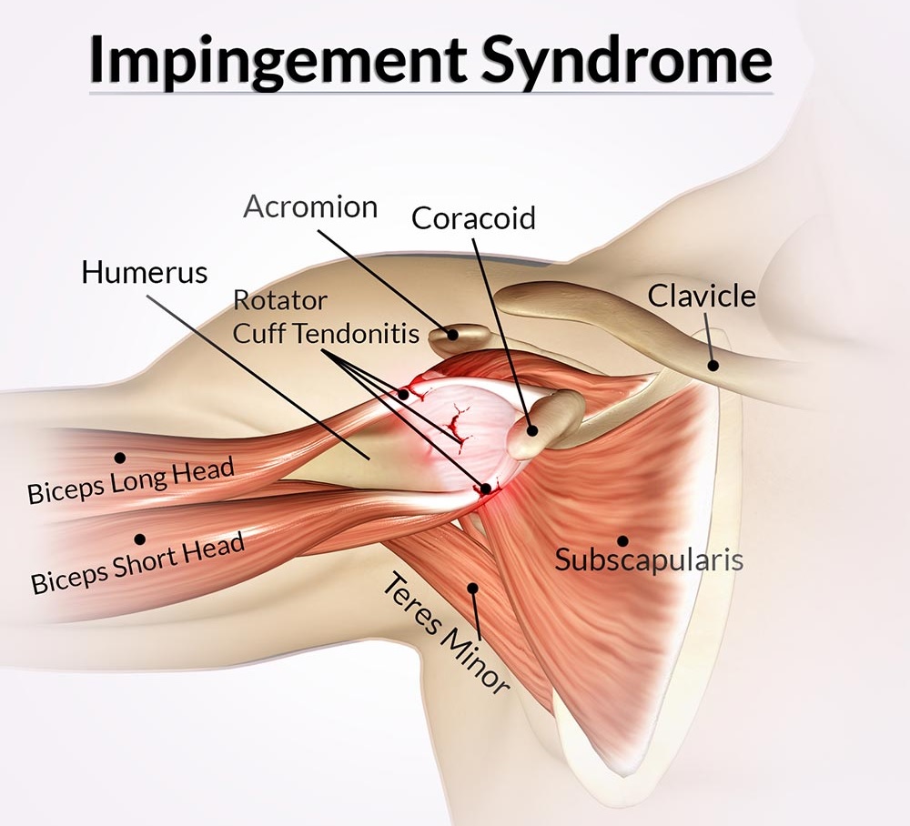 shoulder impingment syndrome