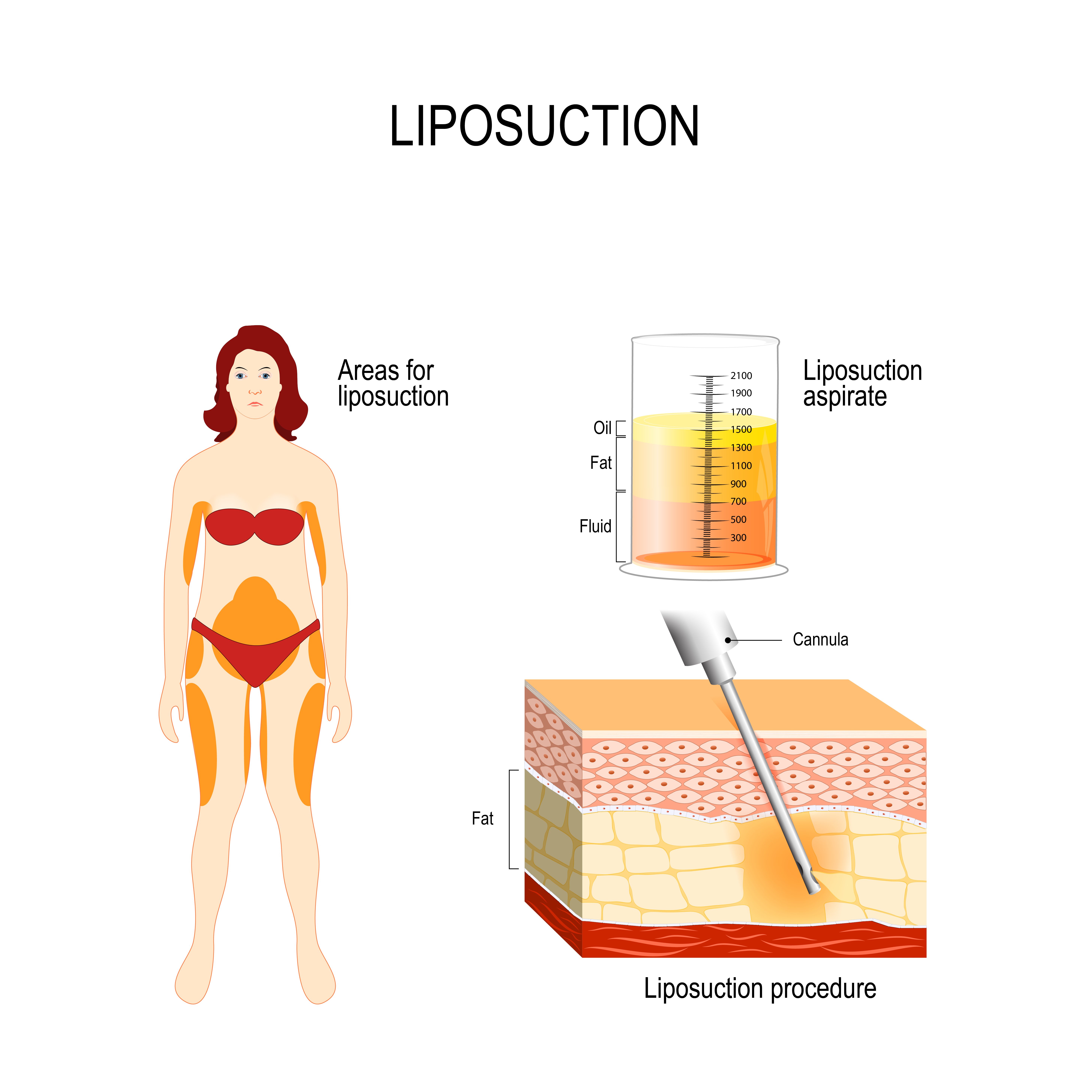 Liposuction Surgery