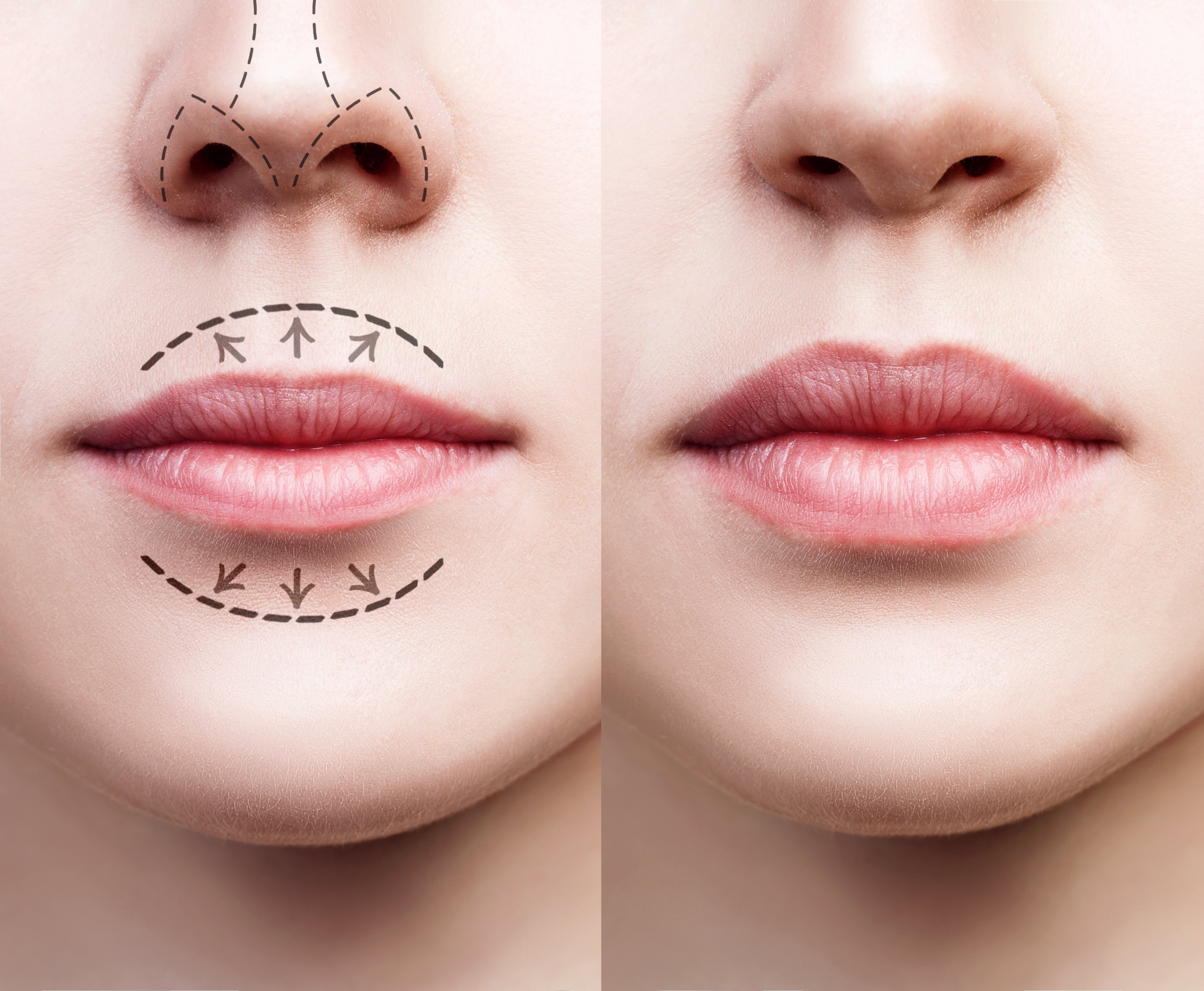 Lip Augmentation