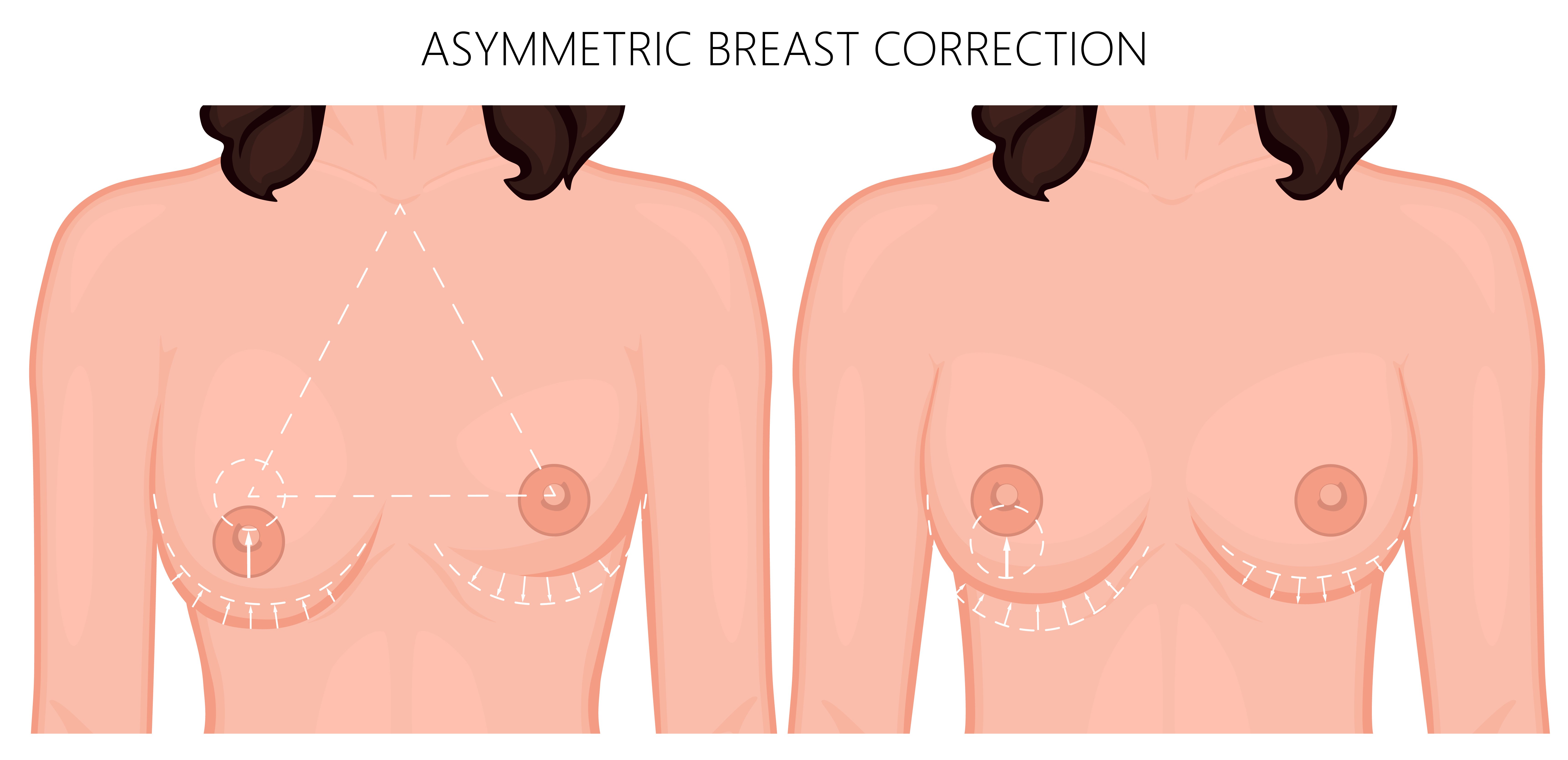 BREAST ASYMMETRY CORRECTION