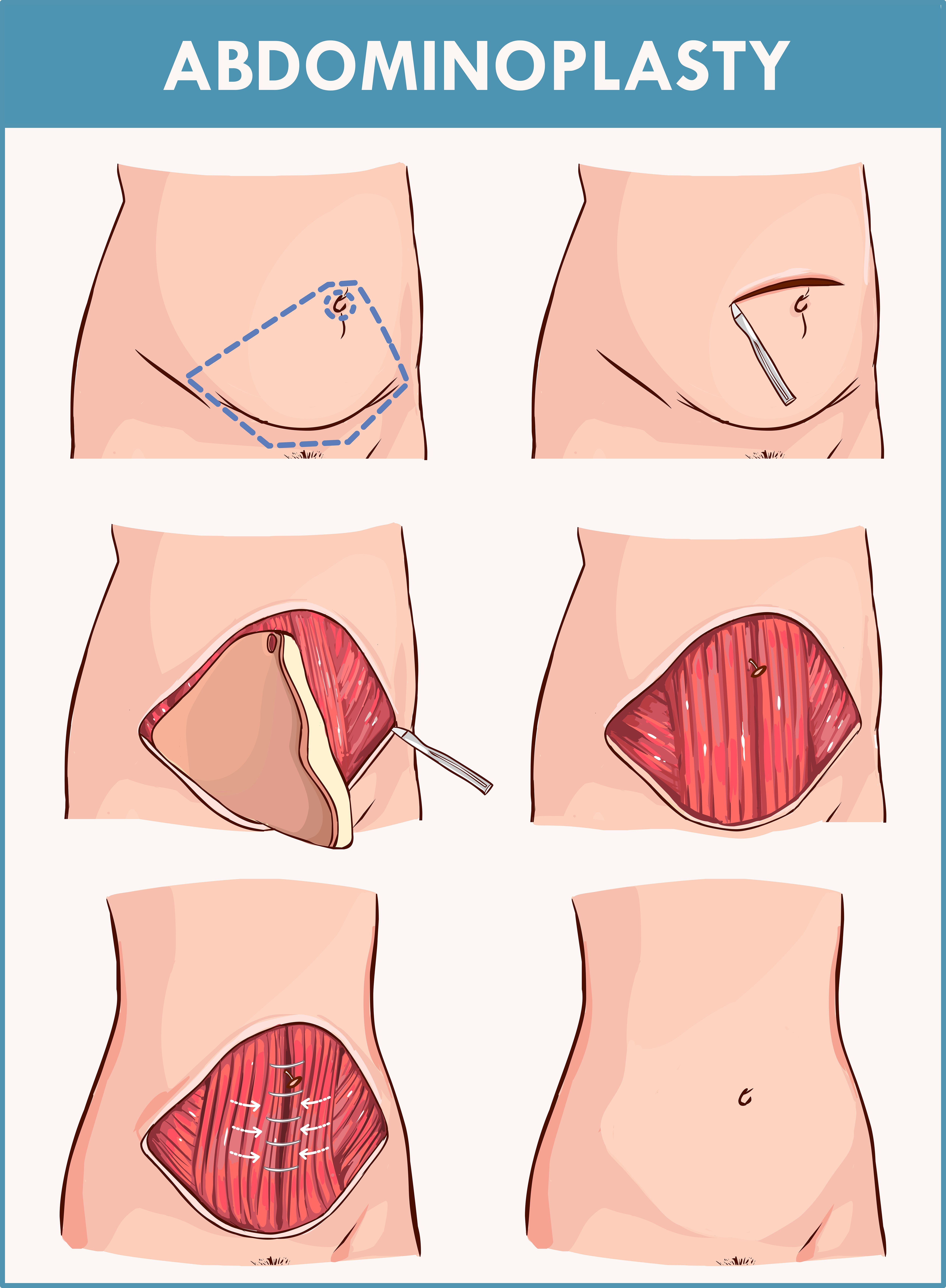 Tummy Tuck Surgery Cost