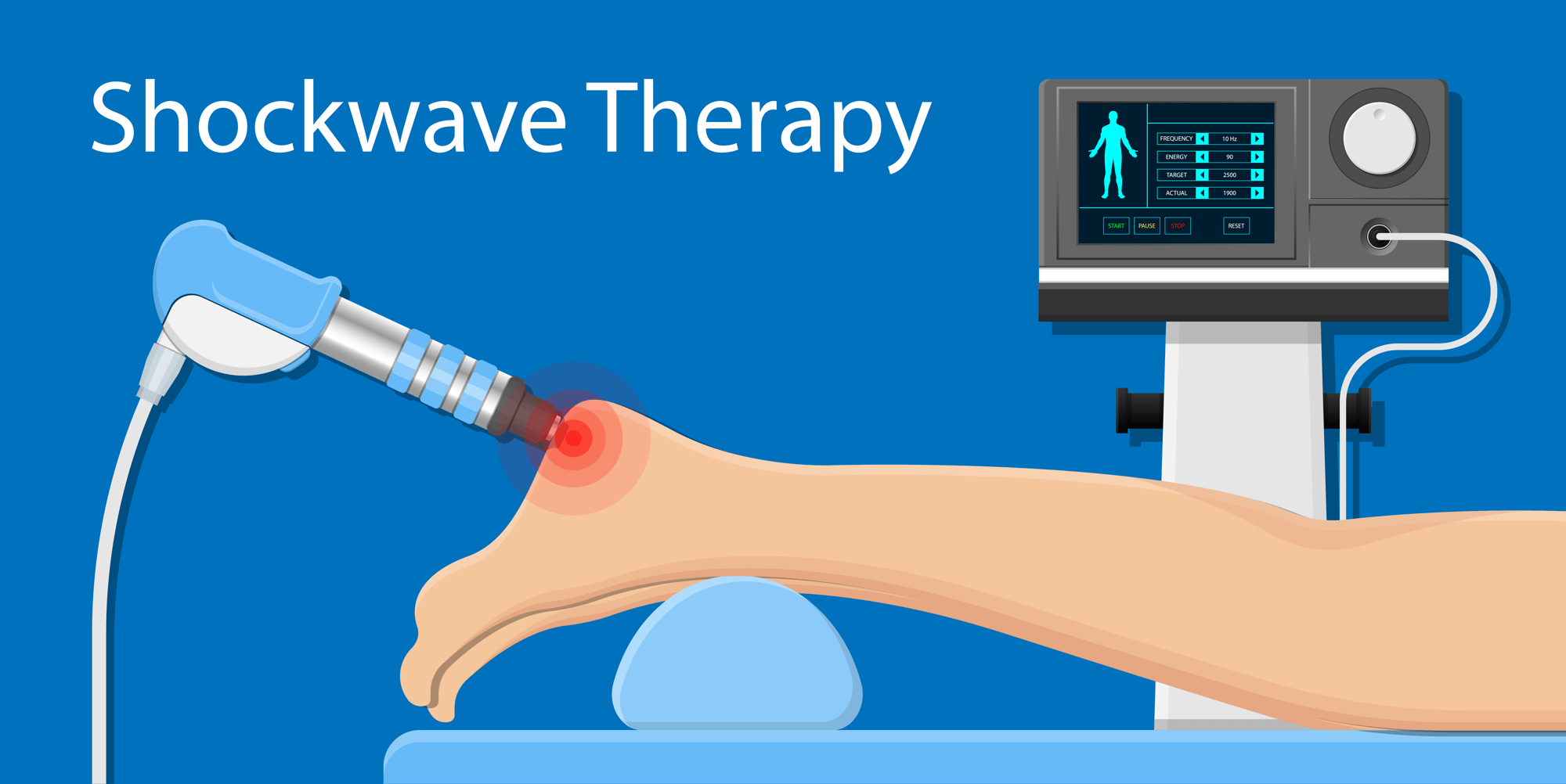 Focused shockwave Therapy