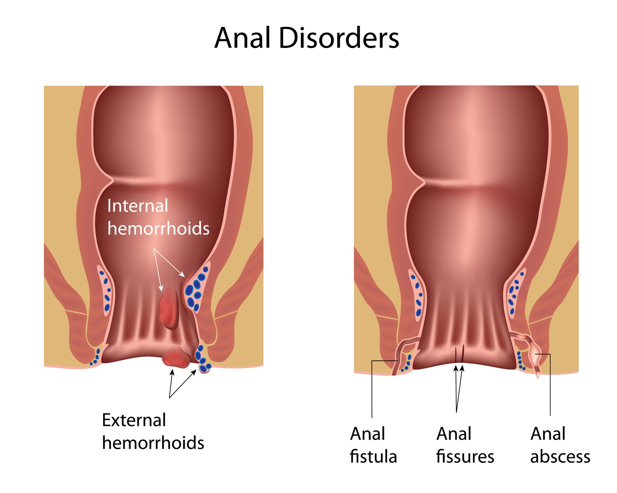 Hemorrhoids dubai