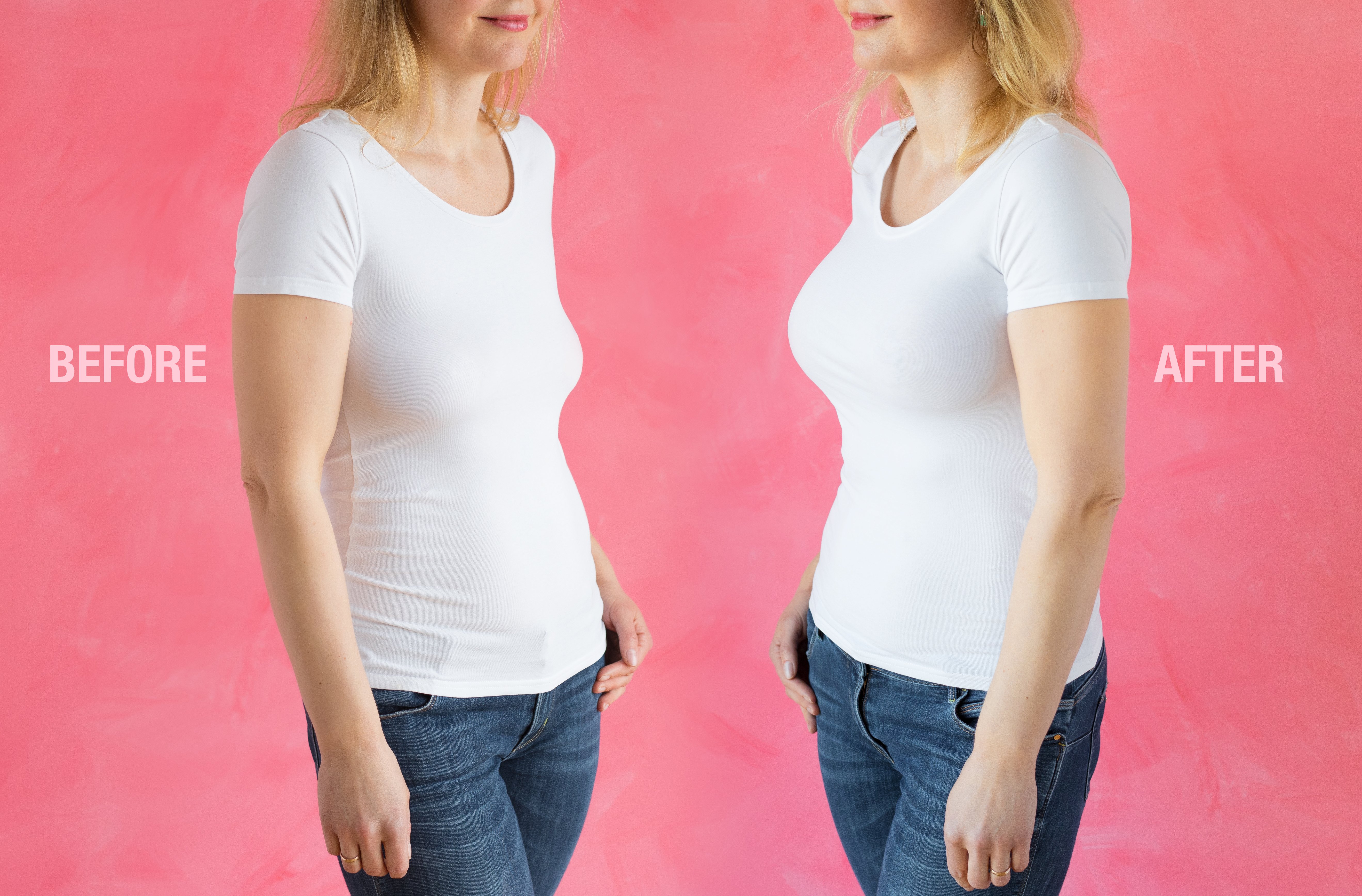 Breast Lift with Augmentation