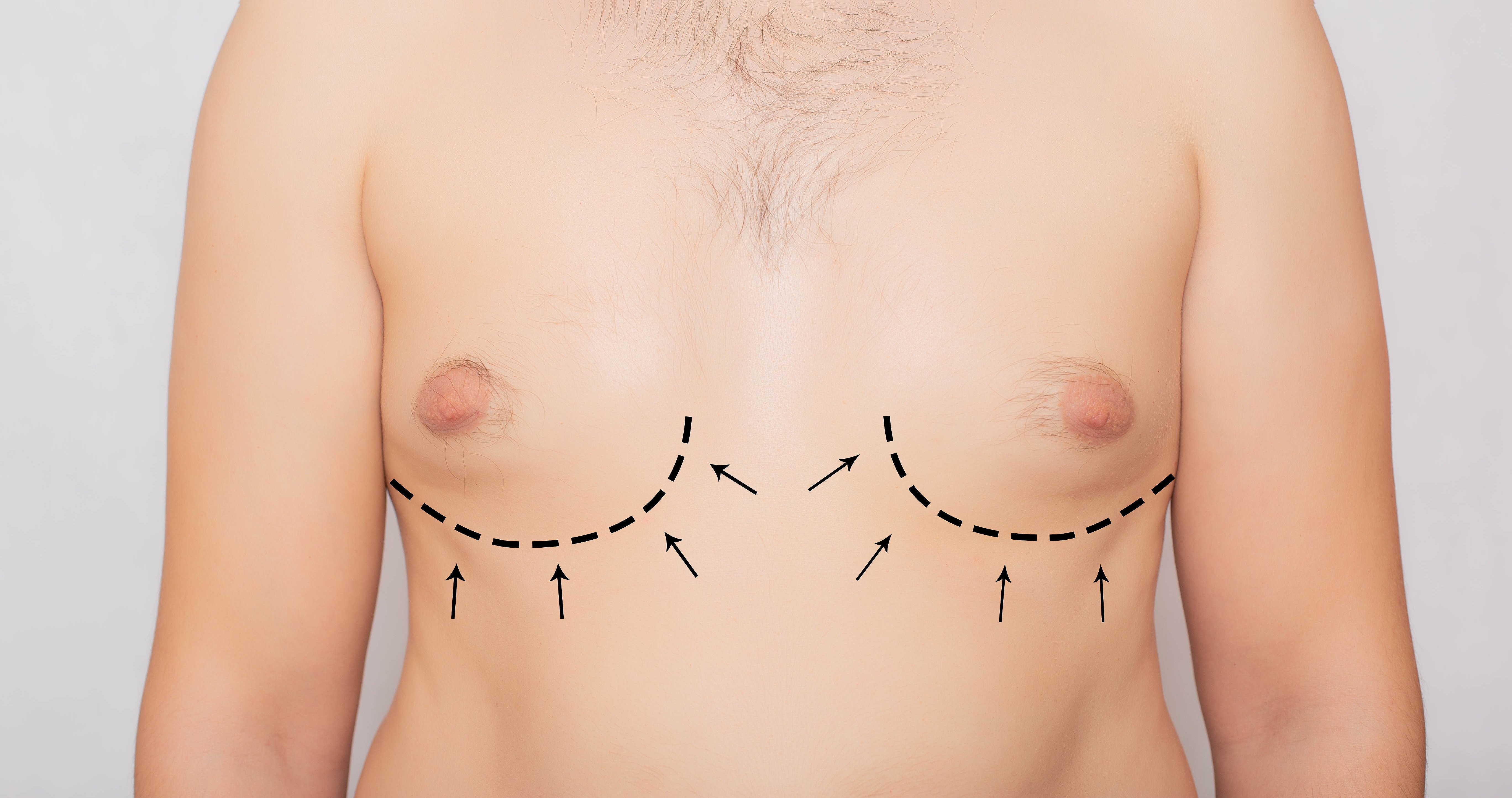 Gynecomastia