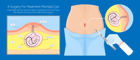 Hemorrhoids dubai