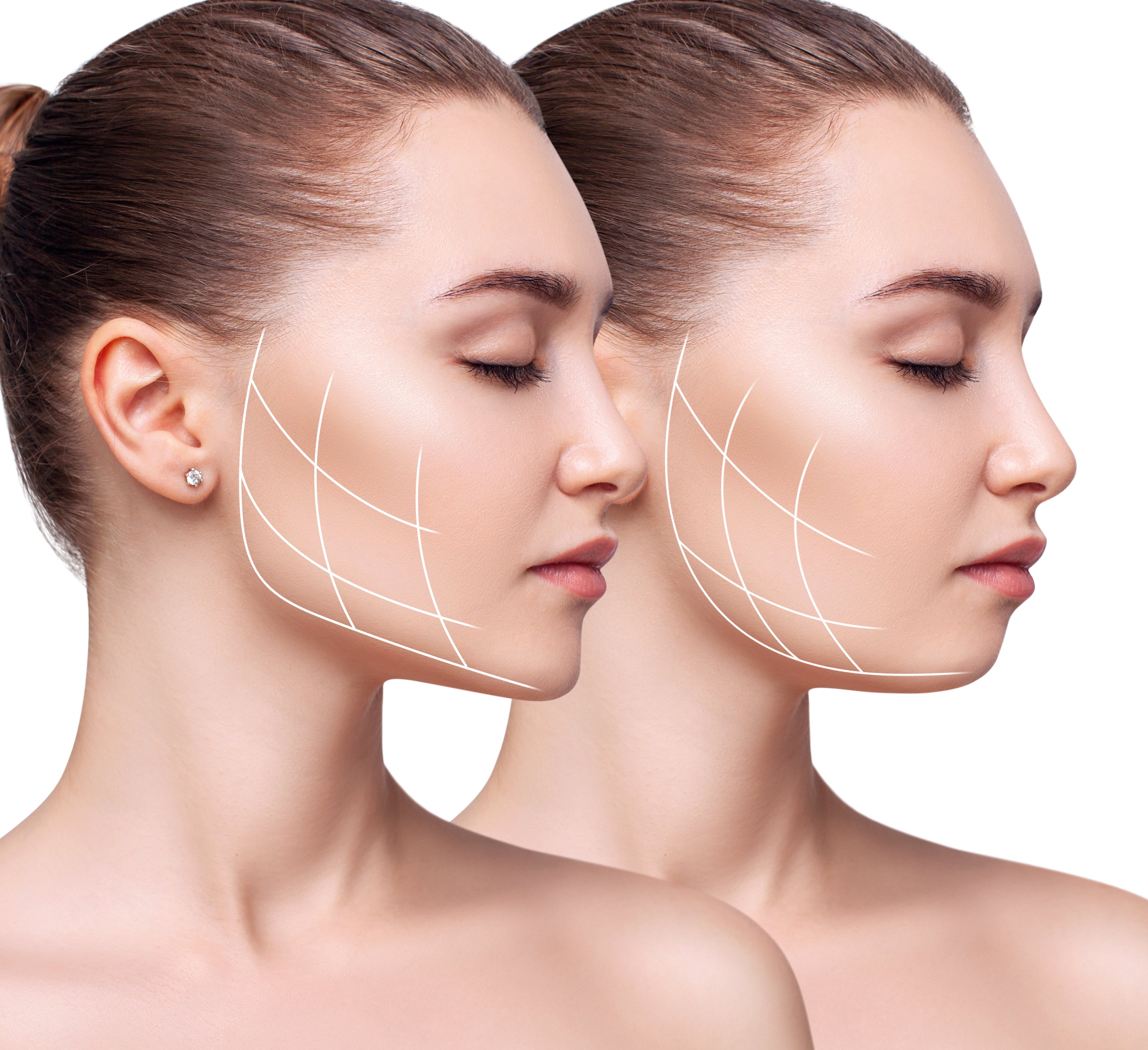 Chin Correction Surgery 