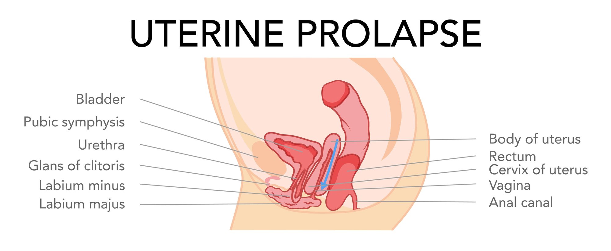 Pelvic Organ Prolapse | DRHC Dubai Gynaecology Clinic