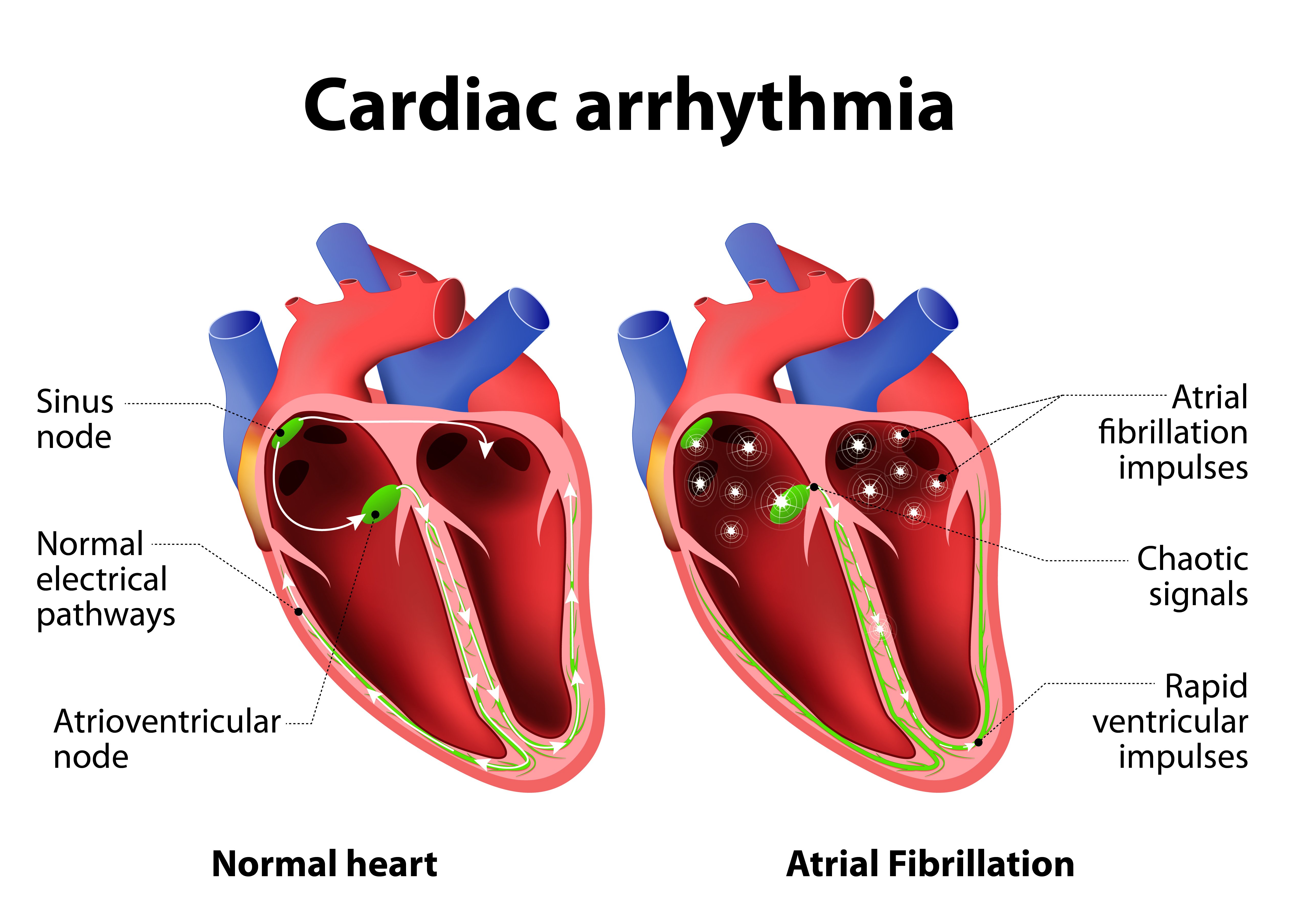 Предсердие болезни. Проводящая система сердца. Проводящая система сердца схема. Аритмия. Аритмия сердца.