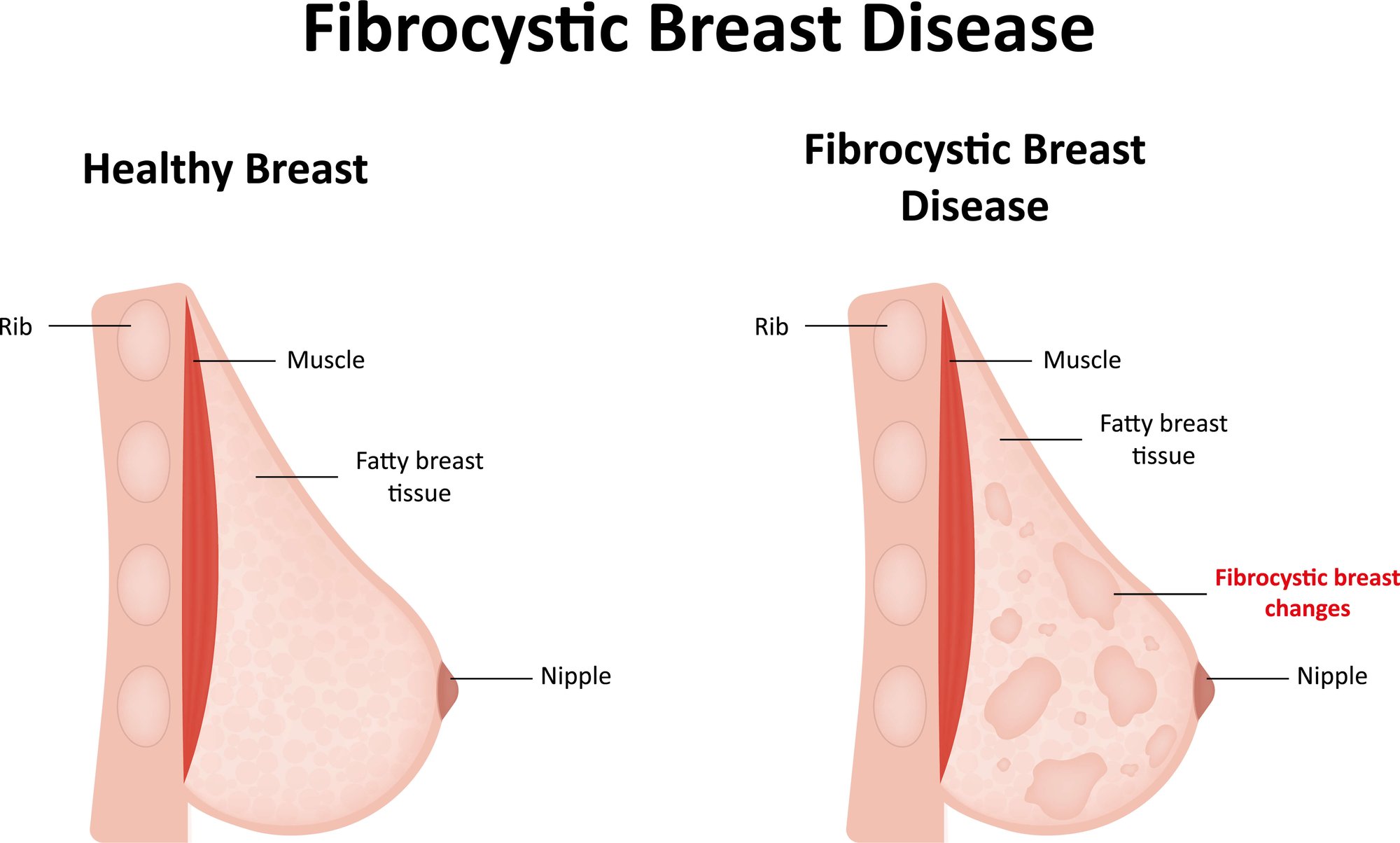 Fibrocystic Breast dubai