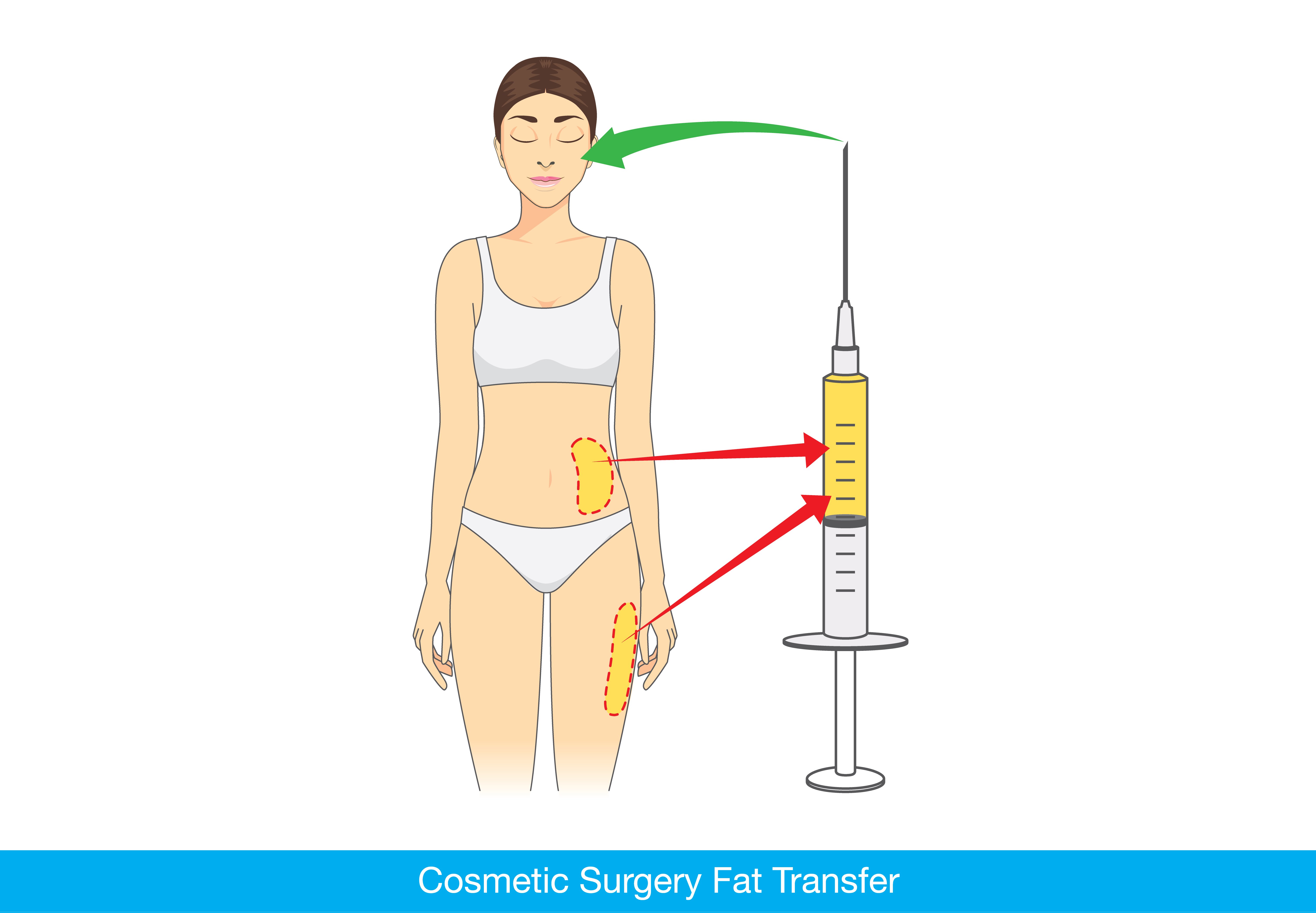 Fat Transfer to Face