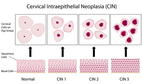 Treatment of Cervical intraepithelial neoplasia