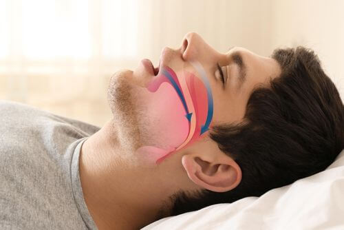 sleep apnea canva (1)