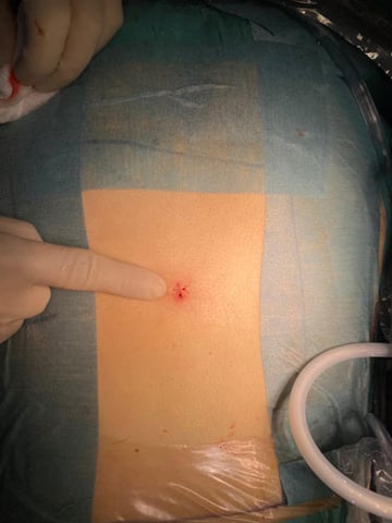 spinal-endoscopic-discectomy