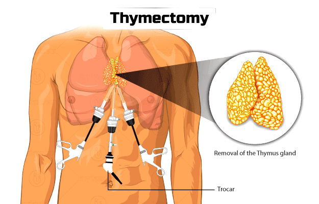 VATS/Open Thymectomy Procedure - DRHC
