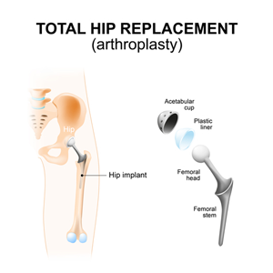 Total Hip Arthroplasty