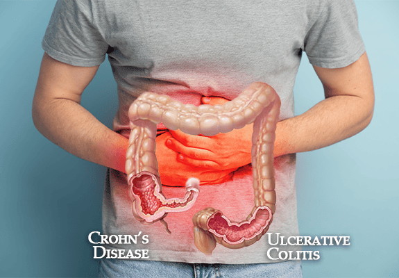 Inflammatory bowel diseases (IBD) 