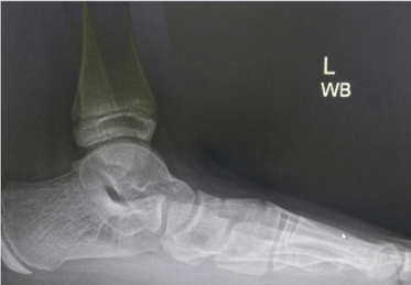 xray of pediatric flatfoot- Dubai Ortopedic clinic