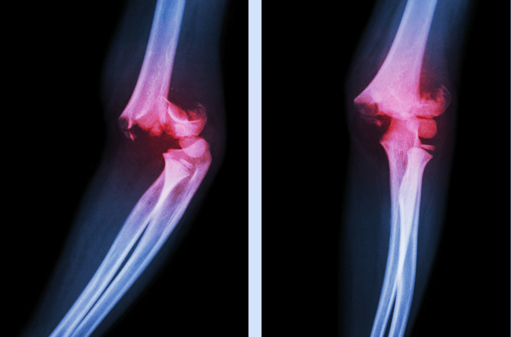 Elbow Fracture and Complication