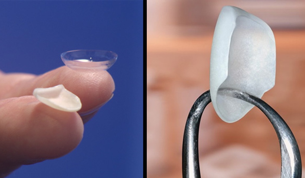 Lumineers Dubai Cosmetic Dental Clinic