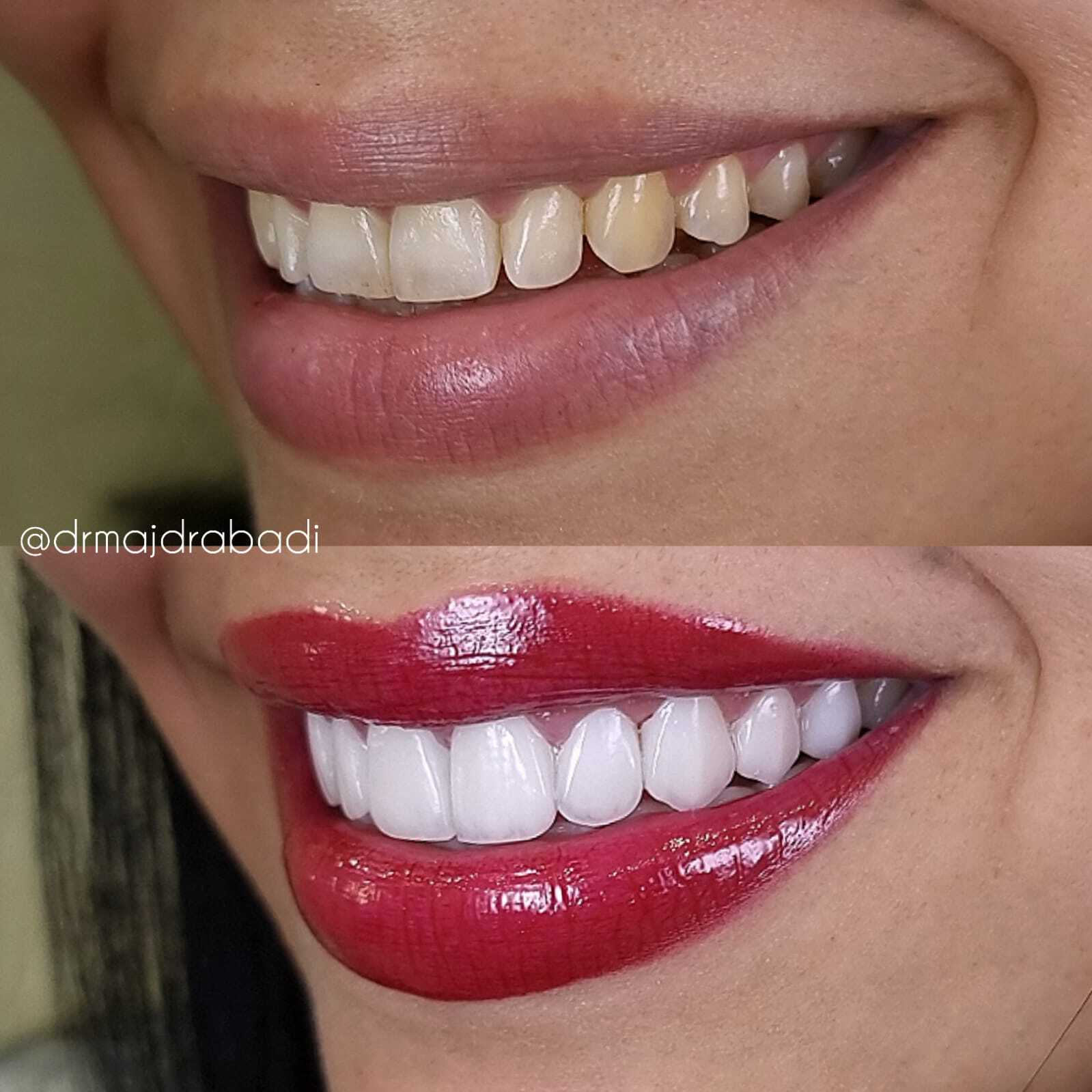 Invisalign Aligners