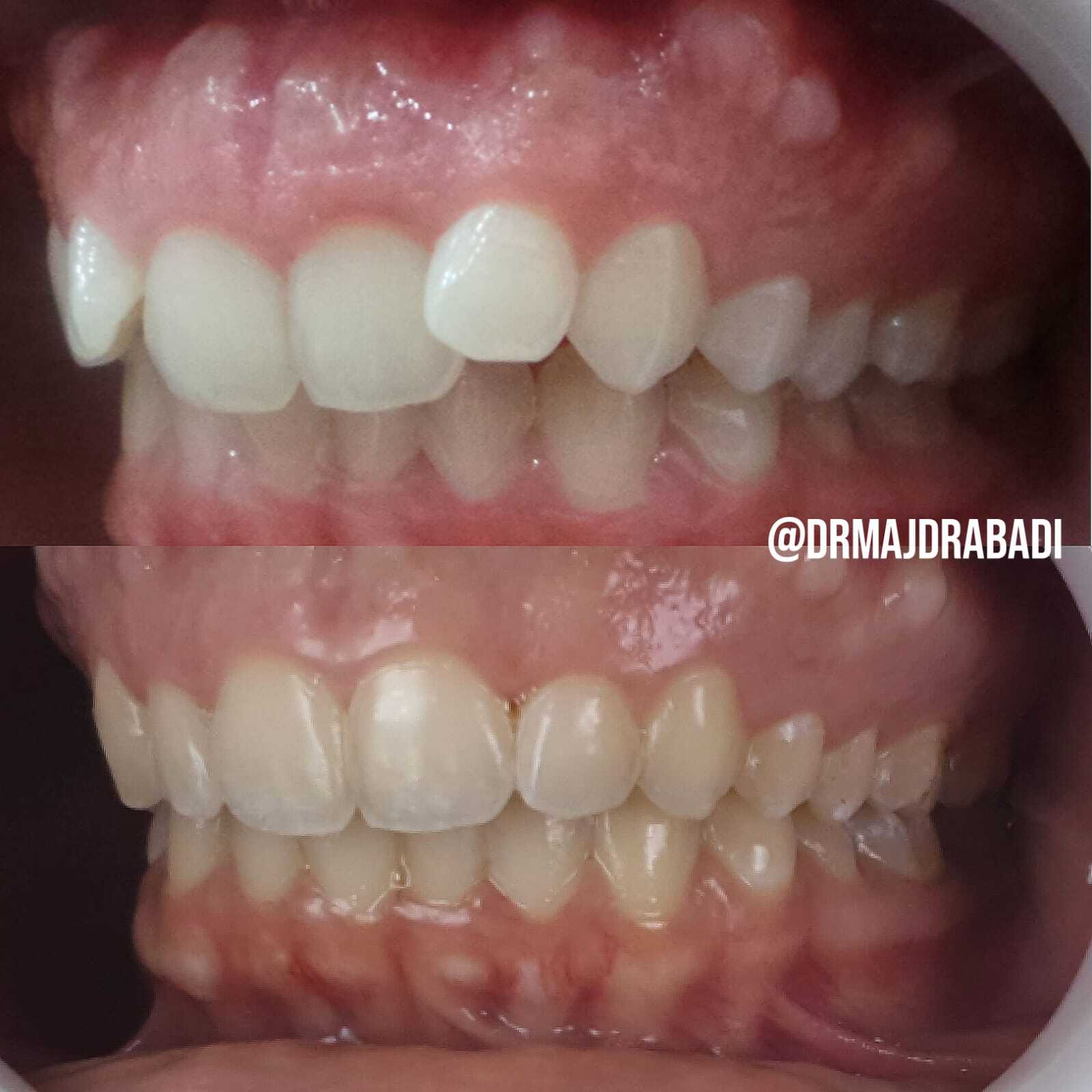 Invisalign Aligners