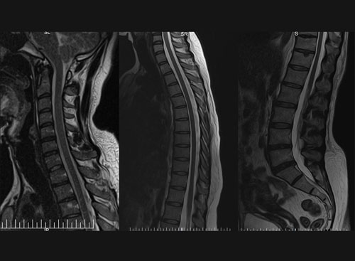 MRI Scan