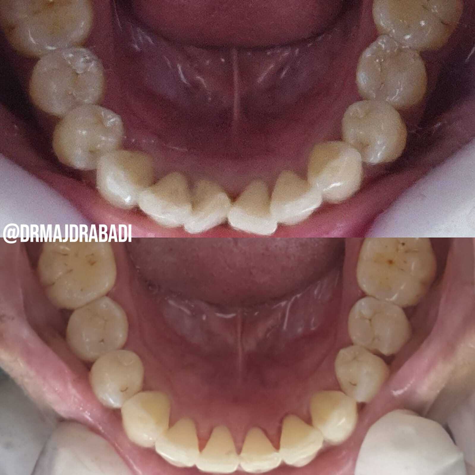 Invisalign Aligners