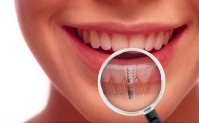 DENTAL IMPLANT