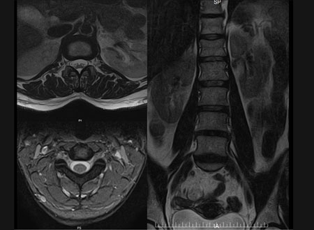 MRI Scan