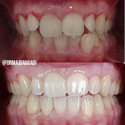 Invisalign Aligners