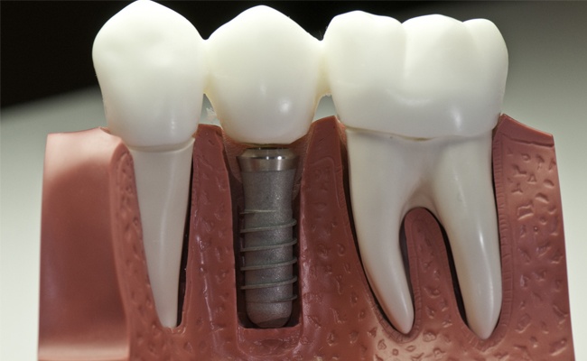 DENTAL IMPLANT