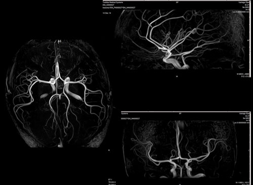 MRI Scan