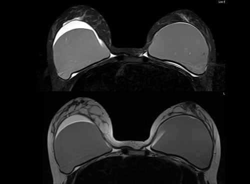 MRI Scan