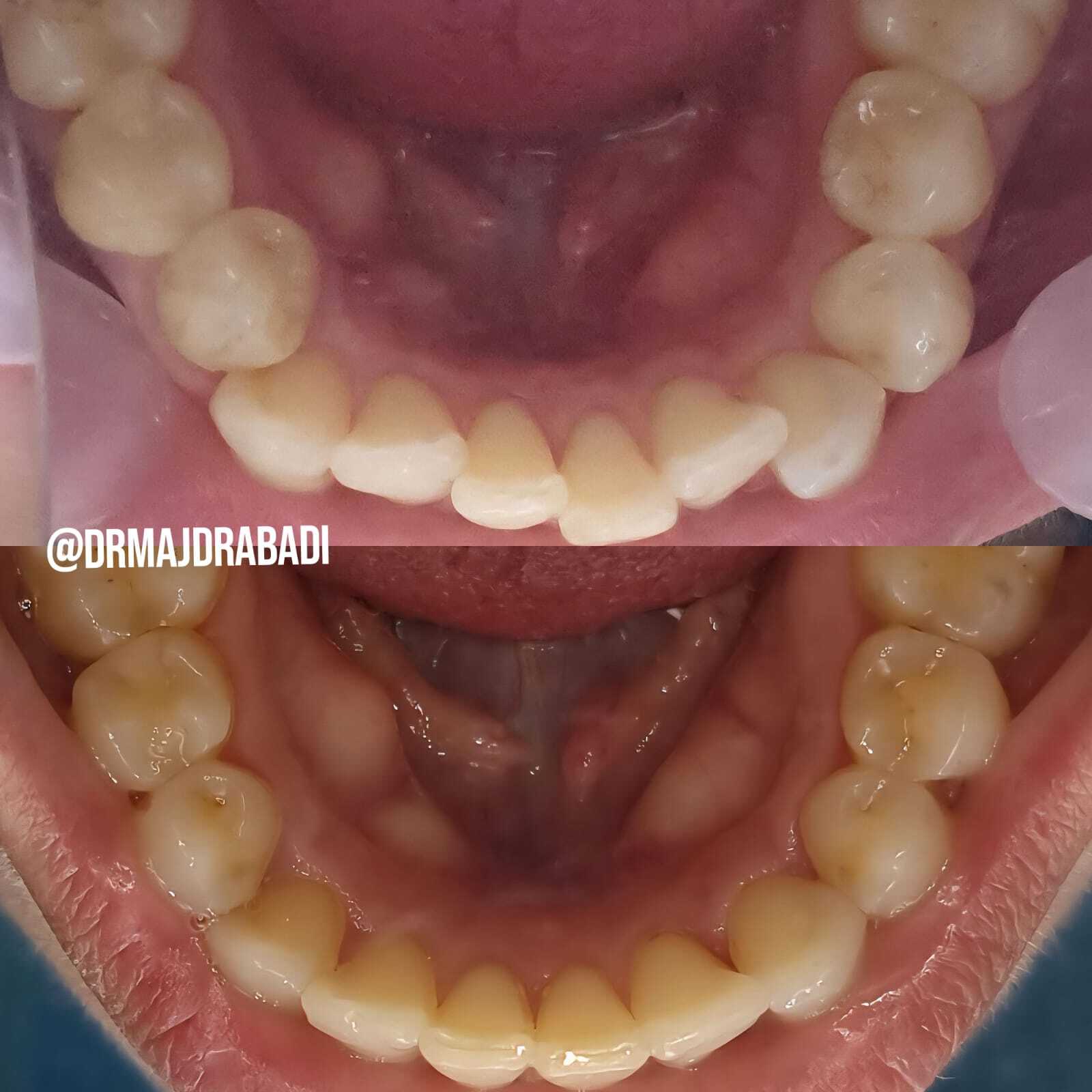 Invisalign Aligners