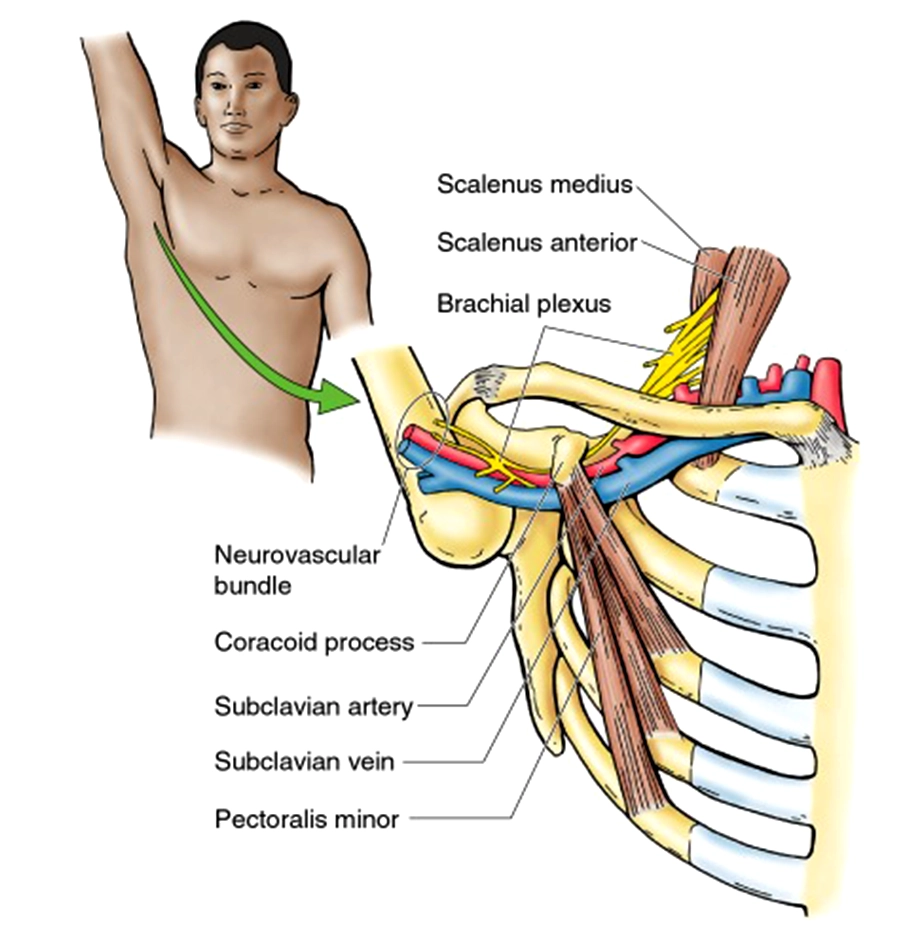 Thoracic Outlet Syndrom - DRHC