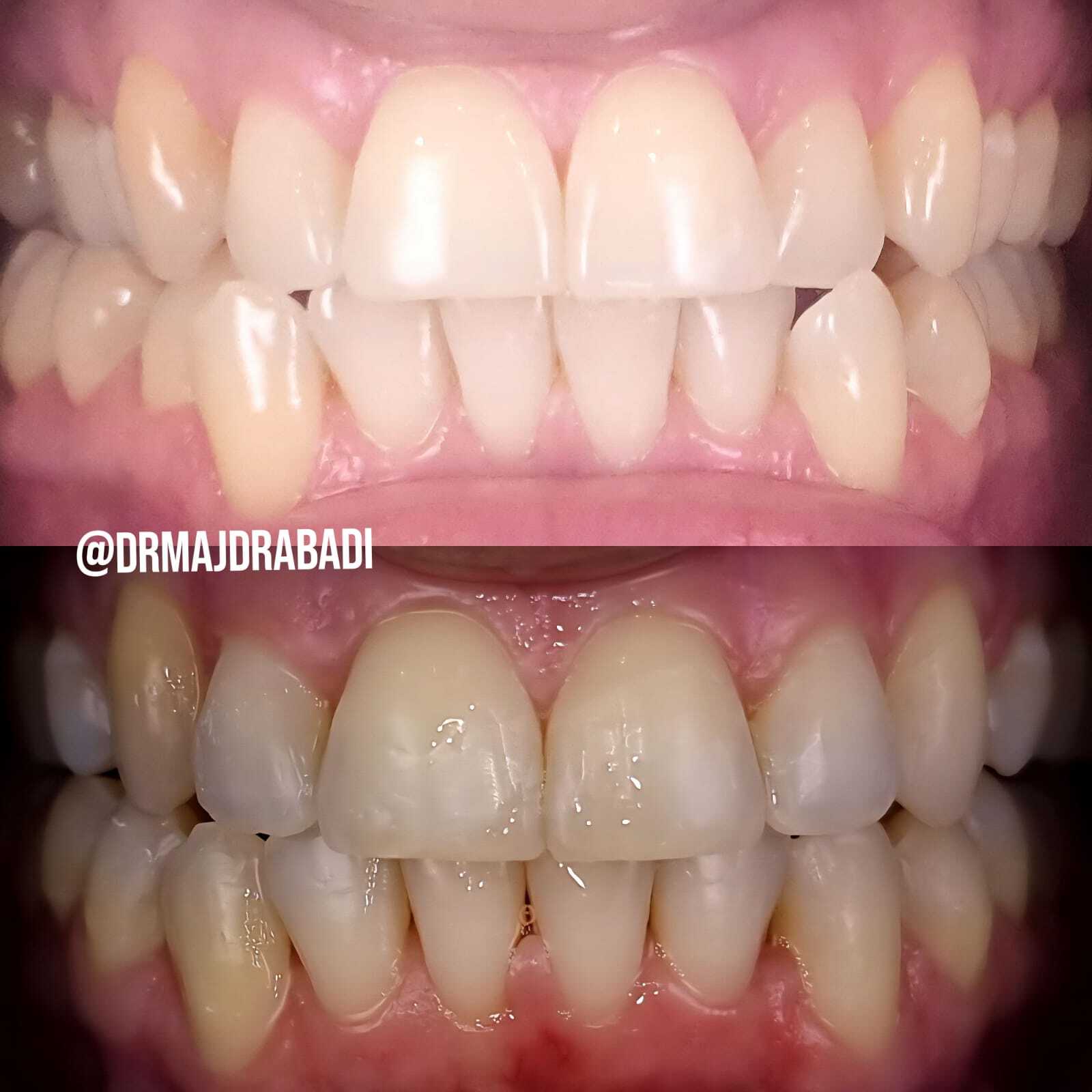 Invisalign Aligners