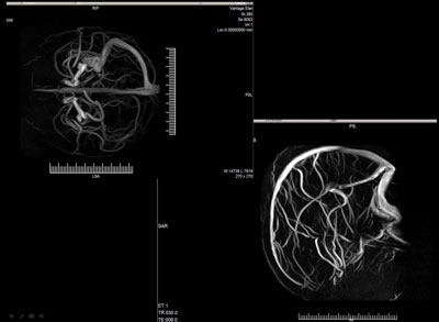 MRI Scan